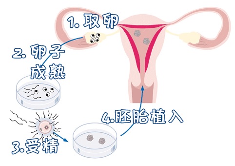 ICSI操作